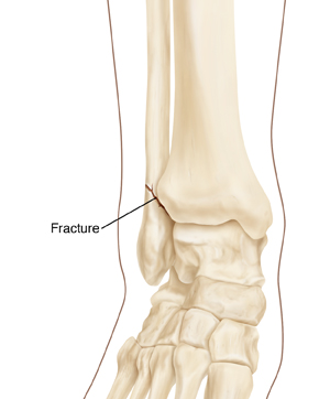 Skeleton view of foot, ankle, and ends of fibula and tibia.