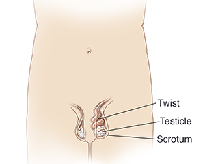 Vista frontal de la pelvis de un hombre que muestra torsión testicular.