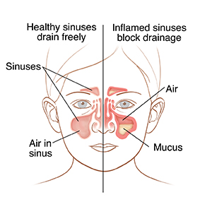 Front view of child's face showing normal sinus anatomy on one side and inflamed sinuses on the other.