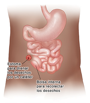Vista frontal del tracto digestivo inferior donde se observa la extracción del colon y el recto, y la estoma de una ileostomía permanente.