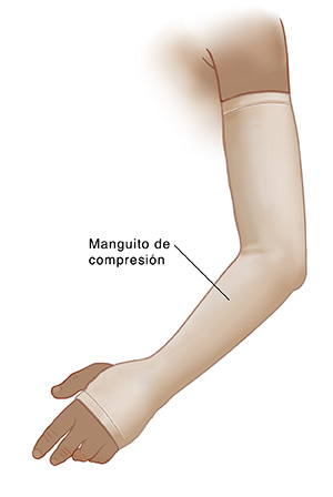 Brazo con manga de compresión.