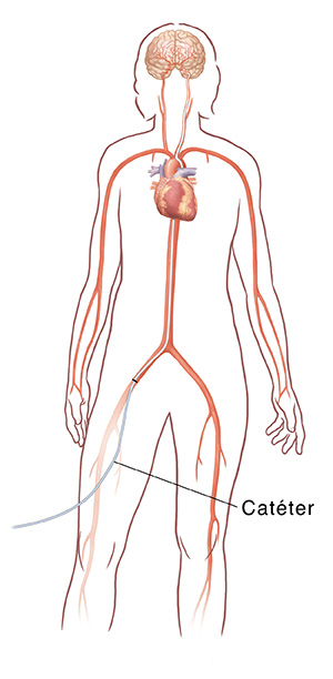 Vista frontal del perfil femenino que muestra el corazón, las arterias principales y el cerebro. Catéter insertado en la arteria ilíaca que va al cerebro.