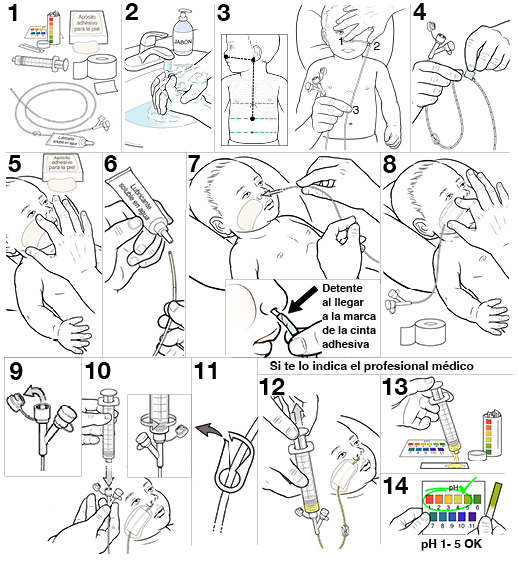 14 pasos para colocarle una sonda nasogástrica a un bebé.