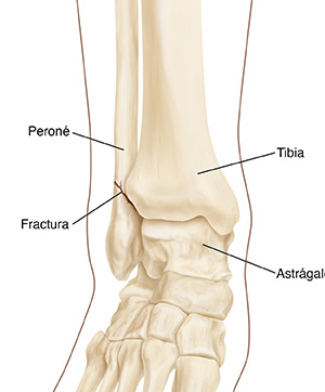 Huesos de la parte inferior de la pierna y del tobillo, incluidos el peroné, la tibia y el astrágalo. El peroné situado cerca de la tibia y el astrágalo muestra una fractura en el hueso.