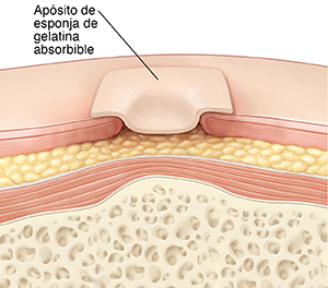 Corte transversal de la piel y una herida donde puede verse un apósito de esponja de gelatina absorbible.