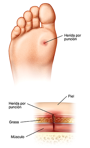 Planta de un pie con herida por punción. Corte transversal de la piel donde se ve una herida por punción.