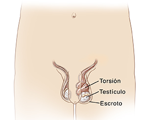 Vista frontal del área pélvica de un hombre en la que se ve una torsión testicular.
