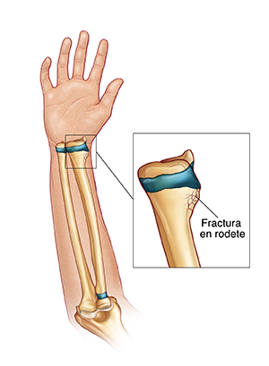 Vista de la cara interna de la mano y del brazo donde se observan los huesos y una fractura en rodete del radio.