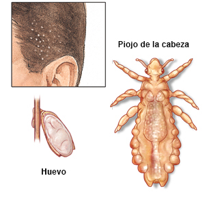 Ilustraciones que muestran una liendre, un piojo adulto y el cuero cabelludo con liendres