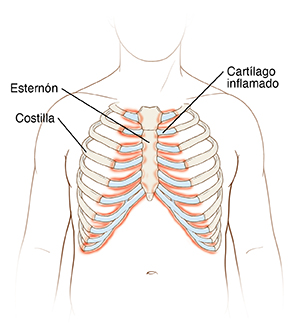 Contorno del torso que muestra la caja torácica. Las costillas están unidas por cartílago al esternón que se encuentra en el centro del pecho. El cartílago está inflamado.