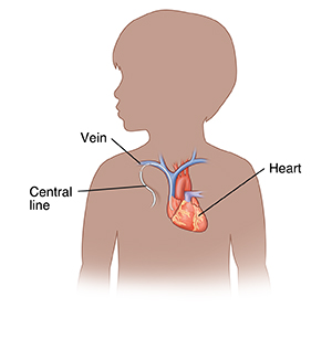 Outline of child showing central line inserted into vein.