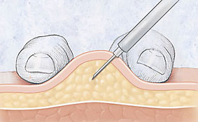 Cross section of fatty area just under skin.